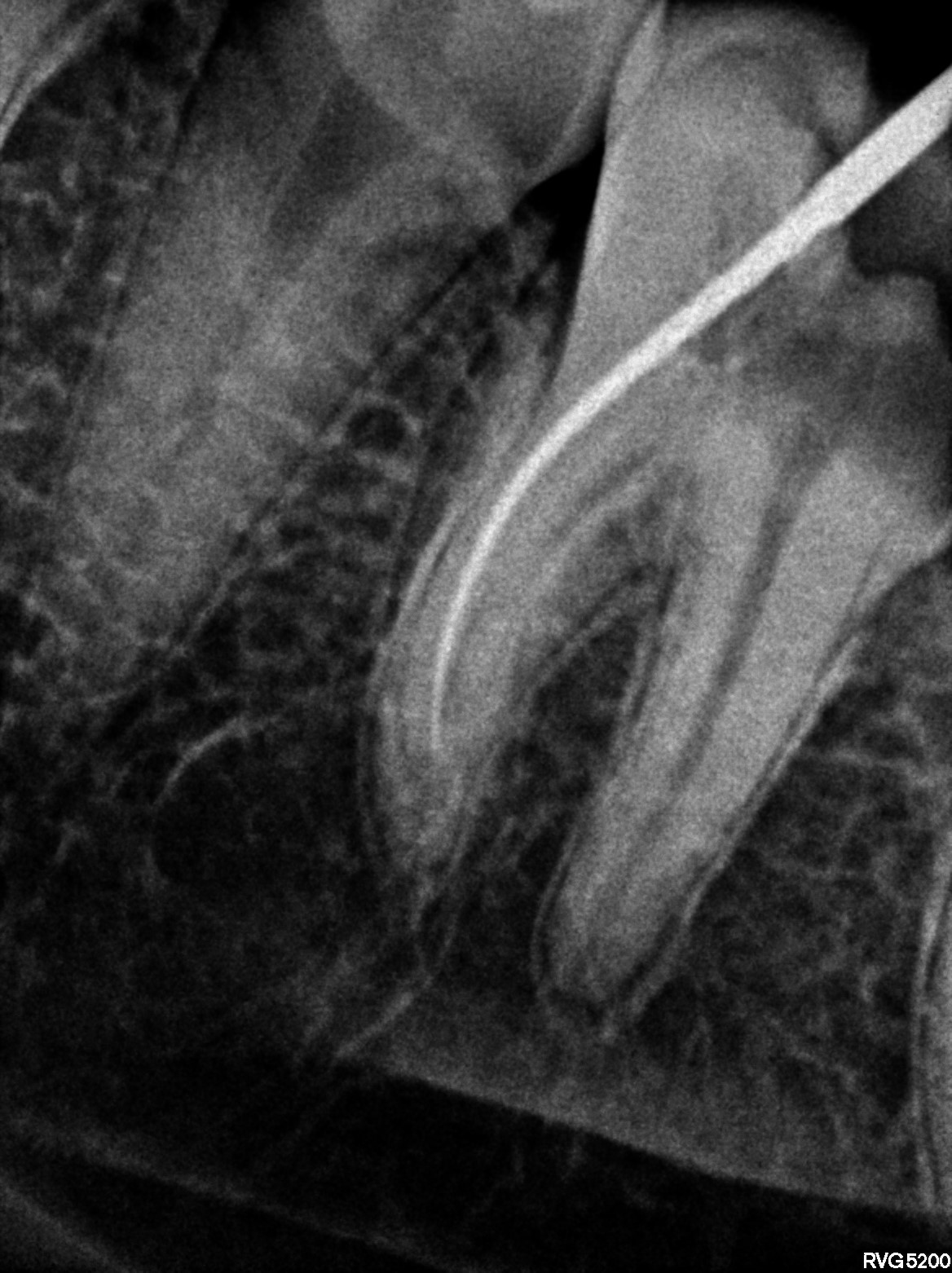 Dental X-ray
